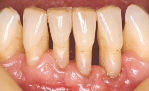 Tænder med synlige rødder pga. parodentose